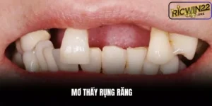 Mơ thấy rụng răng